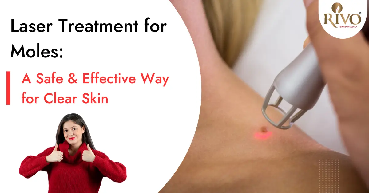 Laser Treatment for Moles: A Safe & Effective Way for Clear Skin