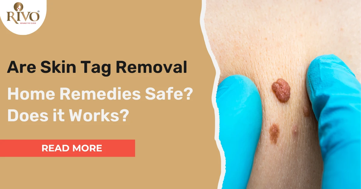 Are Skin Tag Removal Home Remedies Safe? Does it Work?