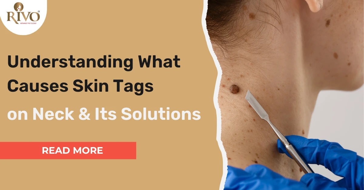 Understanding What Causes Skin Tags on Neck and Its Solutions