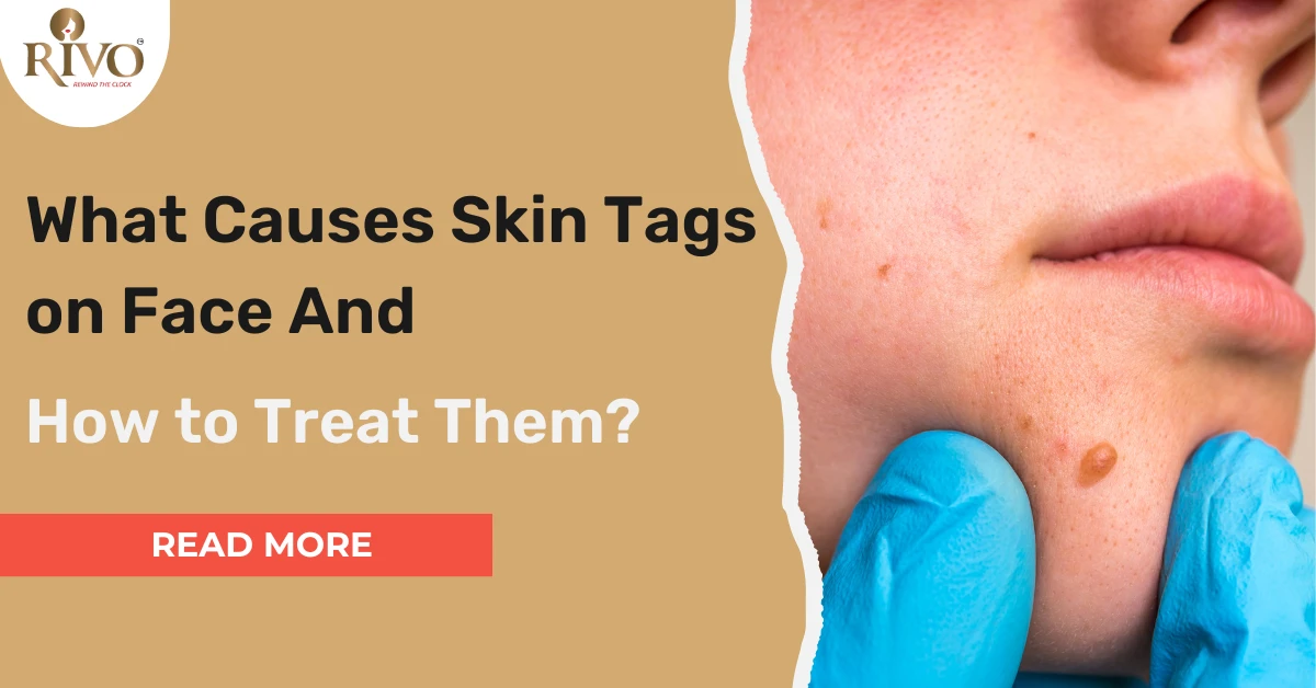 What Causes Skin Tags on Face and How to Treat Them?