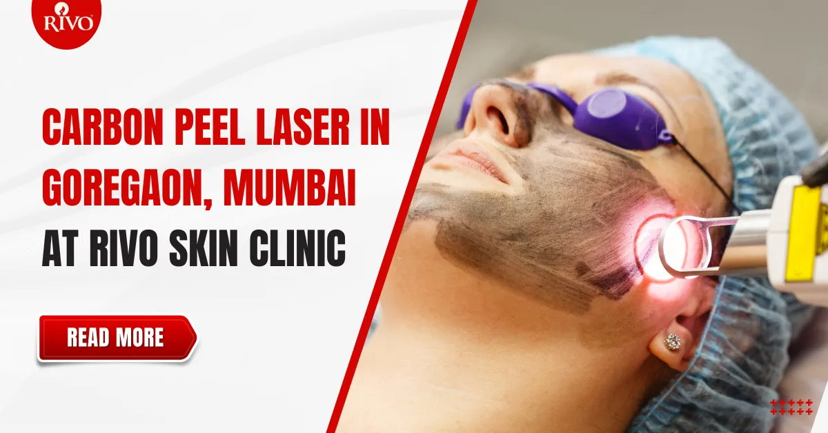 Carbon Peel Laser in Goregaon Mumbai at Rivo Skin Clinic